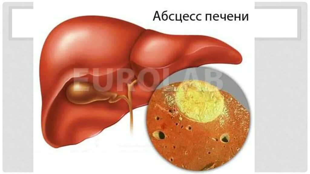 Амебный абсцесс печени. Абсцесс печени амебиаз. Внекишечный амебиаз печень. Амебный абсцесс печени клиника.