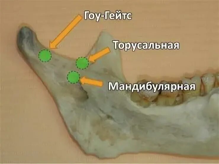 Мандибулярная анестезия нижней челюсти. Проводниковая анестезия нижней челюсти мандибулярная. Торусальная анестезия зона обезболивания. Торусальная анестезия схема.