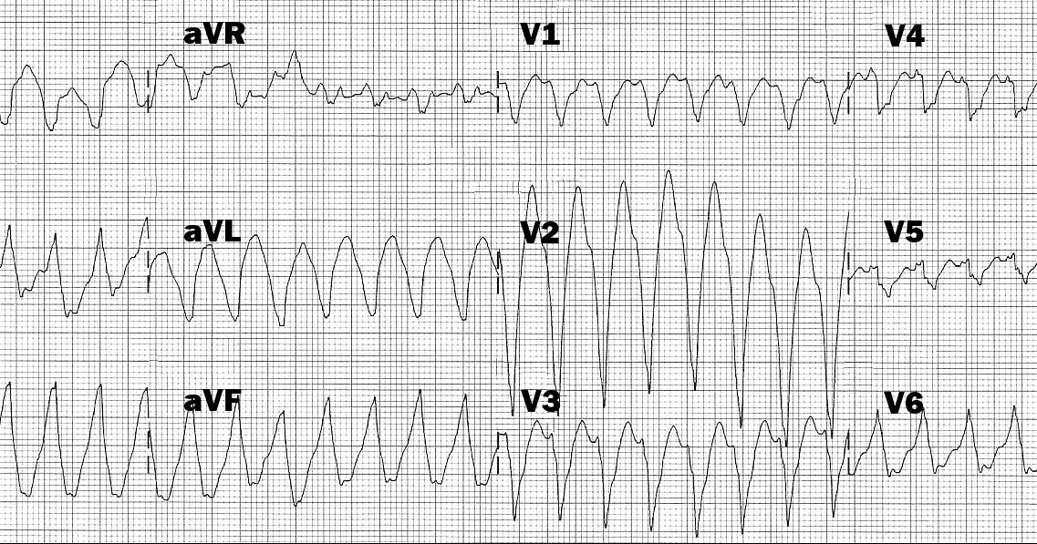 Широкий комплекс qrs. Пароксизмальная тахикардия с широким комплексом qrs на экг. желудочковая тахикардия с широкими комплексами на экг. тахикардия с широкими комплексами qrs на экг. широкий комплекс qrs на экг.