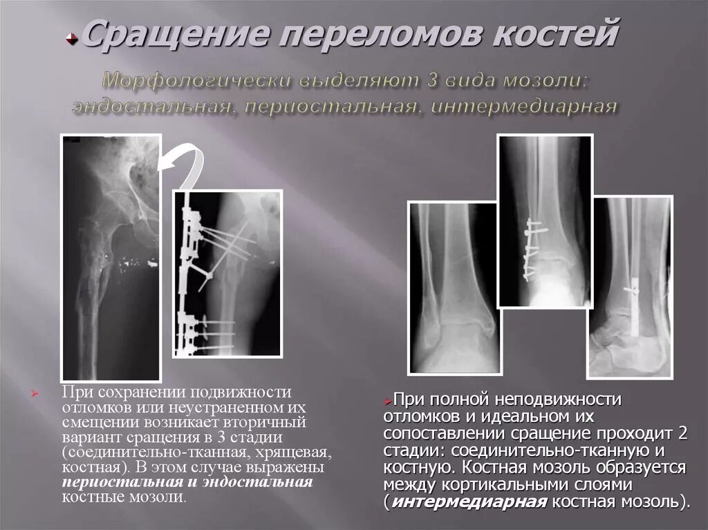 Что такое консолидация перелома. Стадии формирования костной мозоли рентген. Стадии консолидации перелома на рентгене. Параоссальная костная мозоль. Периостальная костная мозоль кт.