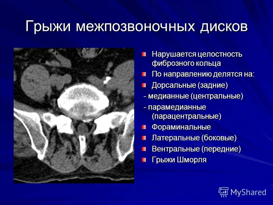 Задняя медианная грыжа. Классификация грыж межпозвонковых дисков мрт. Фораминальная грыжа на кт позвоночника. Классификация грыж позвоночника на мрт. Медианная фокальная протрузия диска.