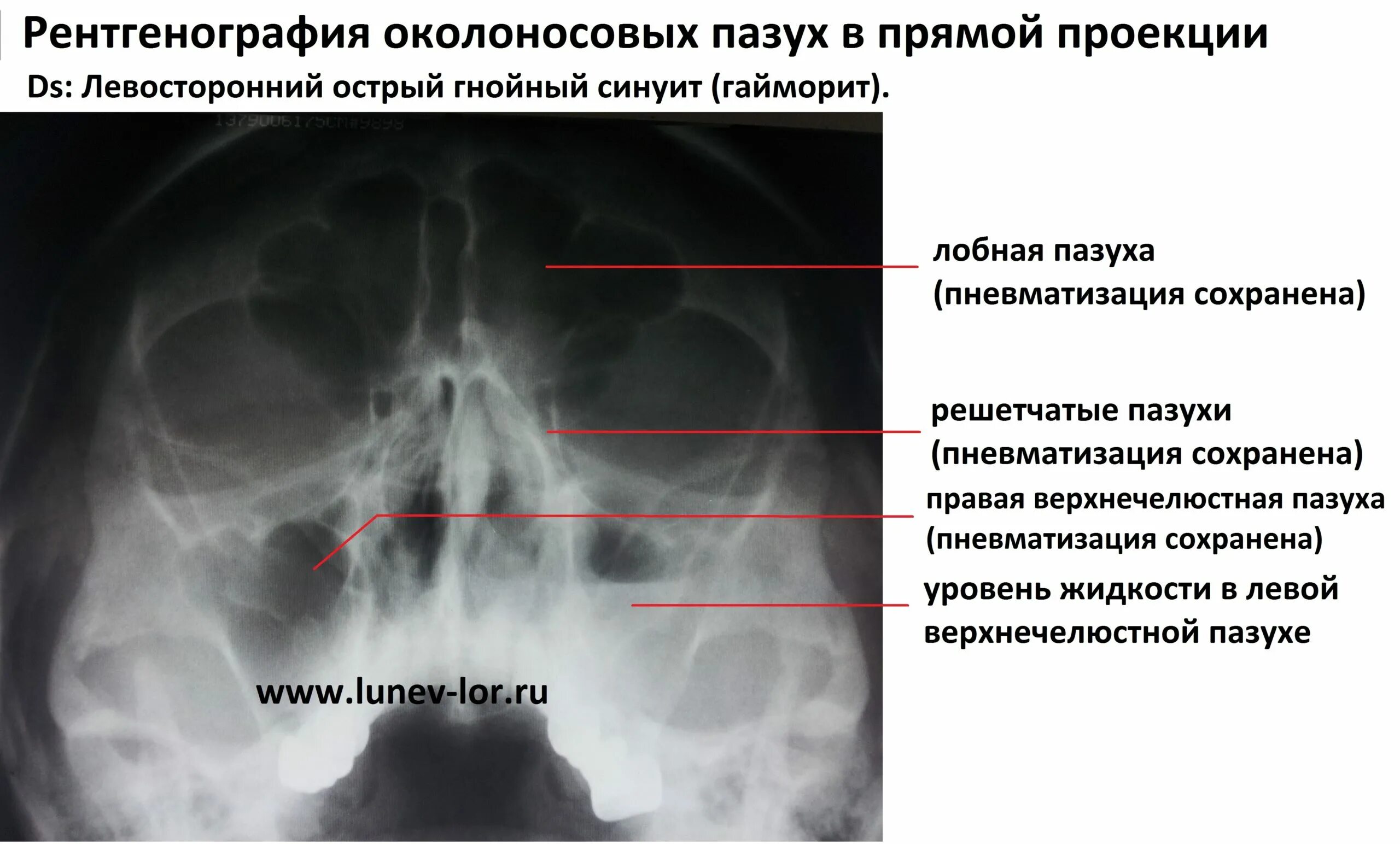 Пристеночный отек слизистой. Правосторонний верхнечелюстной синусит рентген. Рентген придаточных пазух носа синусит. Рентген двустороннего верхнечелюстного синусита. Острый верхнечелюстной синусит на рентгене.