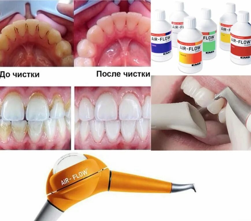 Сколько болят зубы после чистки