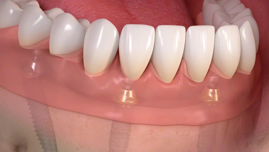 Абатмент осстем. Мостовидный имплант на 3 зуба. Циркониевые абатменты. Несъемные протезы на имплантатах. Имплантаты dentium superline.