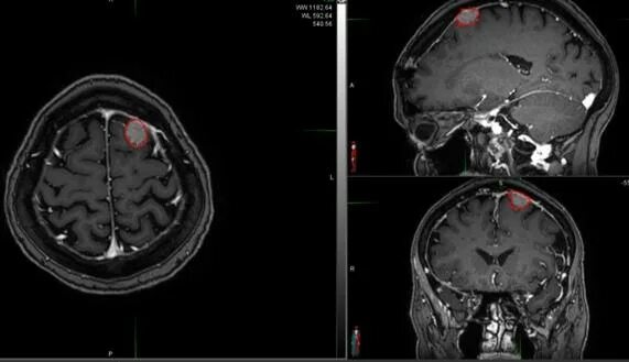 Лечение метастазов мозга. Метастазы головного мозга кт. Метастазы меланомы в головной мозг мрт. Метастаз в головном мозге кт мрт. Метастазы меланомы в головной мозг кт.