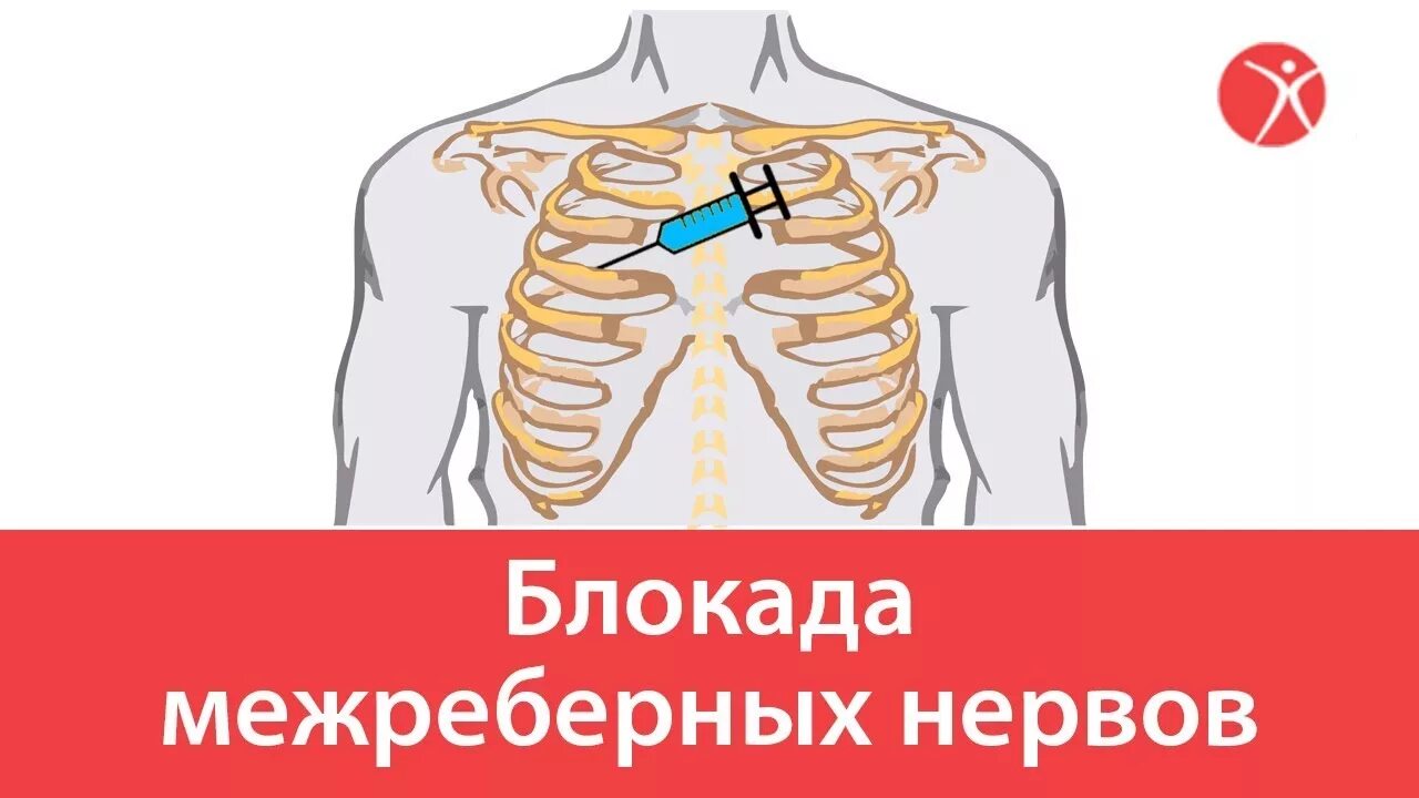 Межреберная блокада. Блокада межреберных нервов. Новокаиновая блокада межреберных нервов. Межреберная невралгия блокады.