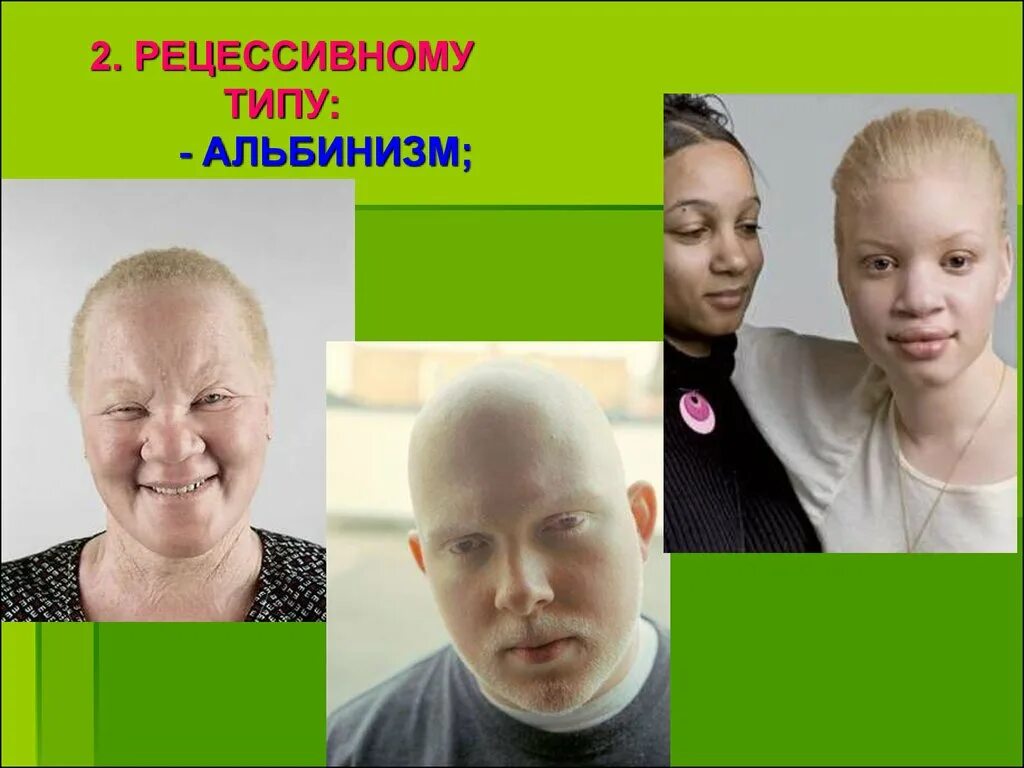 Альбинизм генетика. Глазокожный альбинизм тип 2. альбинизм генная мутация. глазокожный альбинизм типы.