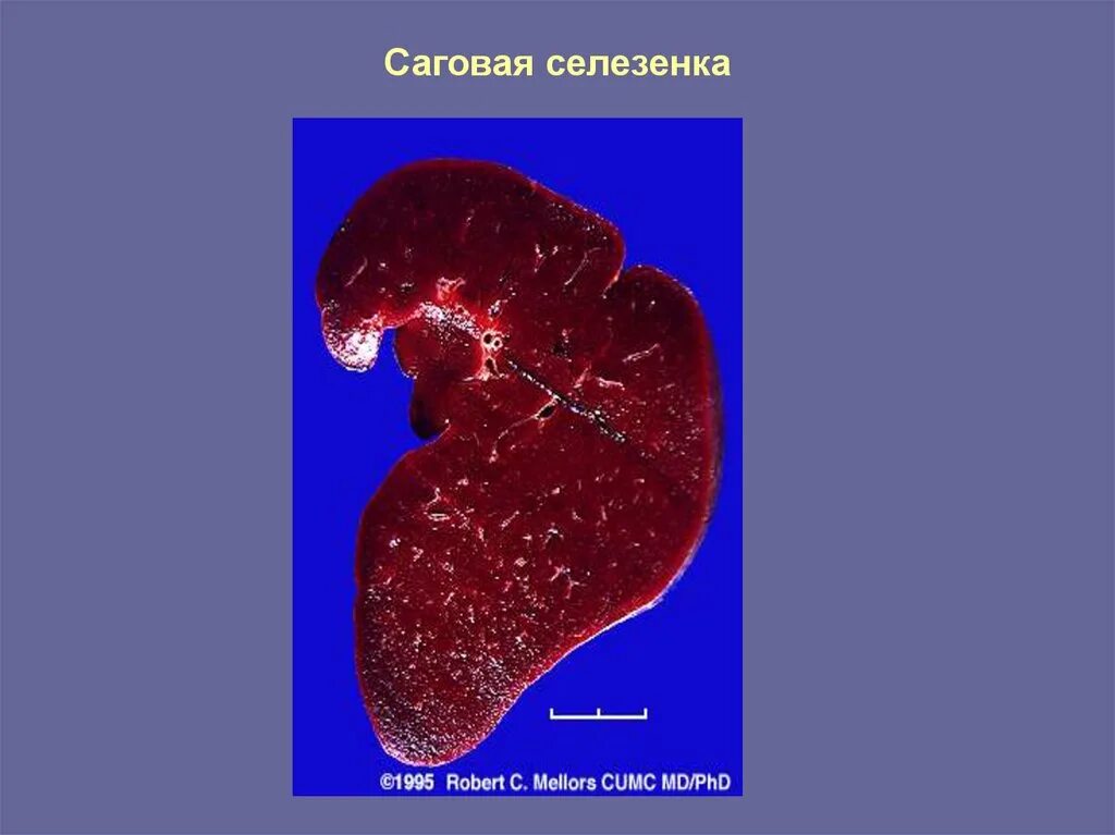 Селезенка армия. Амилоидоз селезенки макропрепарат. Саговая селезенка микропрепарат. Сальная селезенка макропрепарат. Гиалиноз капсулы селезенки.