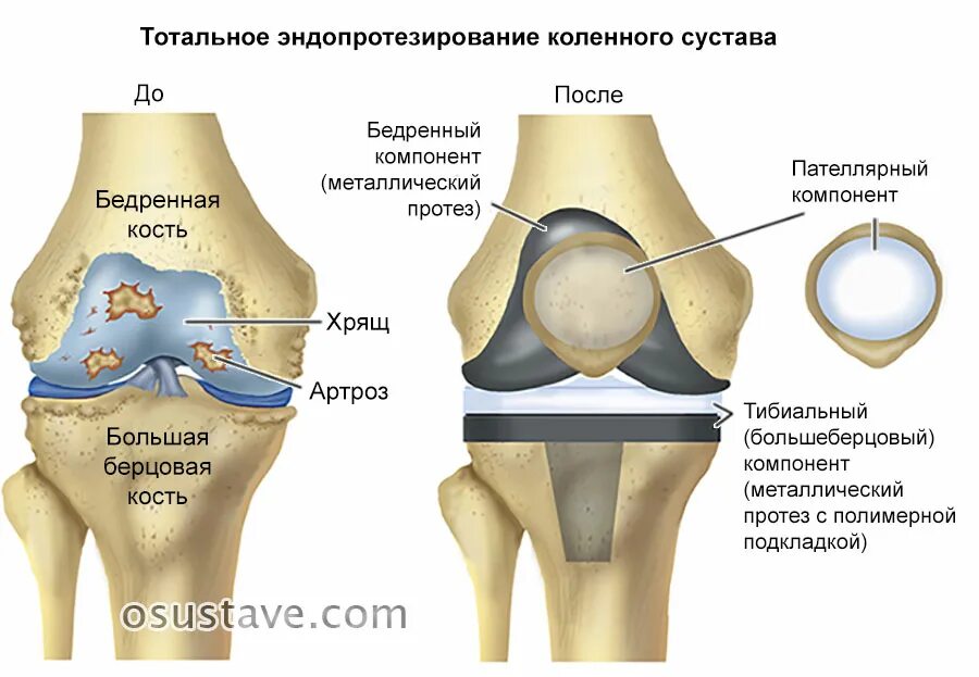 Как выглядит коленного. Феморальный компонент эндопротеза коленного сустава. артроз коленного сустава эндопротез. схема эндопротезирования коленного сустава. схема операции эндопротезирования коленного сустава.