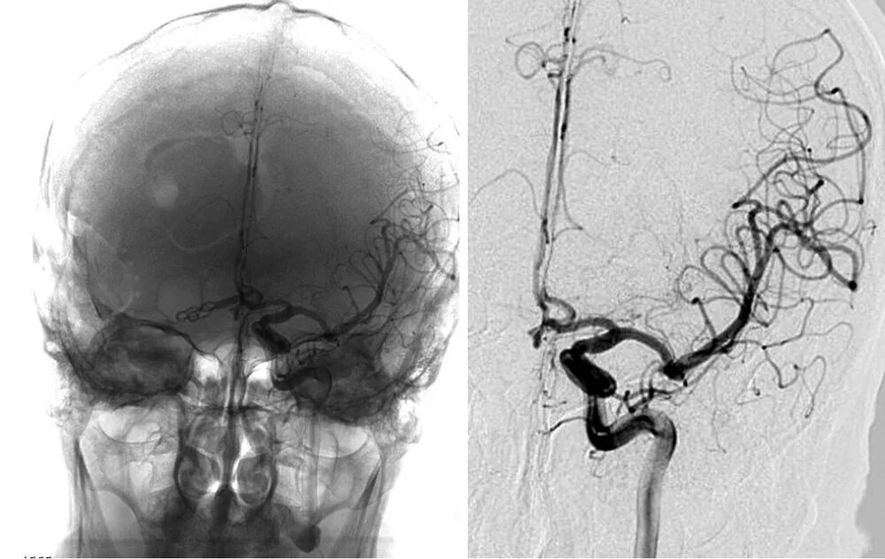 Сосуды головного мозга норма. Каротидная ангиография головного мозга. Мрт ангиография сосудов головного мозга. Аневризма сосудов головного мозга кт ангиография. Мрт головного мозга с ангиографией.