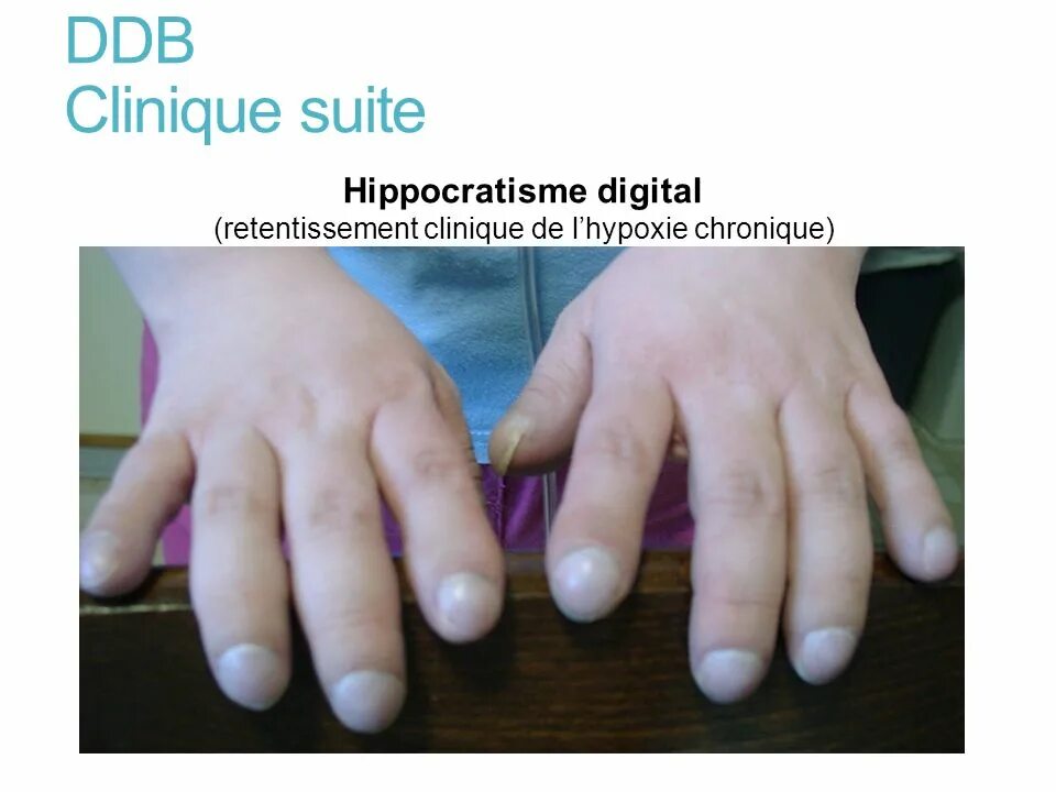 Изменение фаланг пальцев. Барабанные палочки ногти гиппократа. Симптом барабанных палочек. Симптом барабанных палочек патогенез. Симптом барабанных палочек на ногтях.