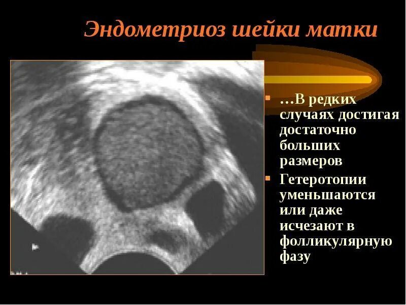 Признаки внутреннего эндометриоза на узи. Гетеротопии эндометриоза матки. Эндометриоз шейки матки. Эндометриоз шейки матки на УЗИ.