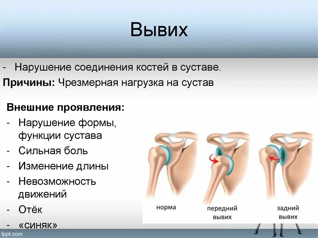 Почему вылетают суставы. Почему вылетают суставы