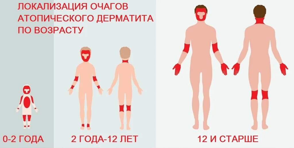 Атопический дерматит у детей атд. Локализация атопического дерматита. атопический дерматит причины у взрослых. атопический дерматит локализация у взрослых. атопический дерматит места локализации.