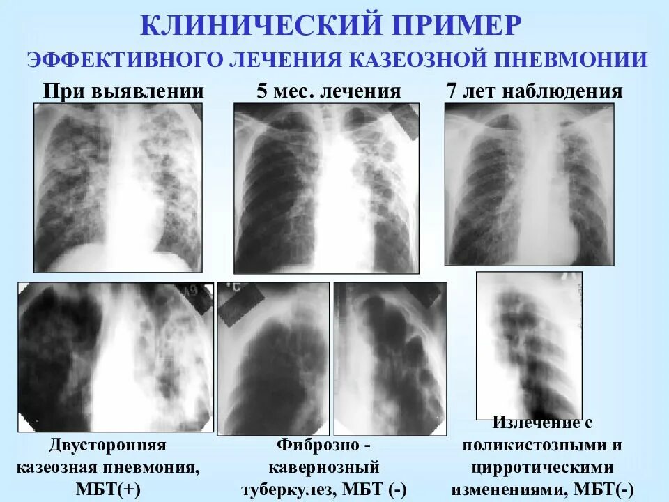 Туберкулез сколько лет