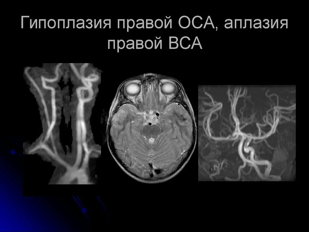 Гипоплазия позвоночной артерии мрт. Гипоплазия внутренней сонной артерии. Гипоплазия внутренней сонной артерии кт.