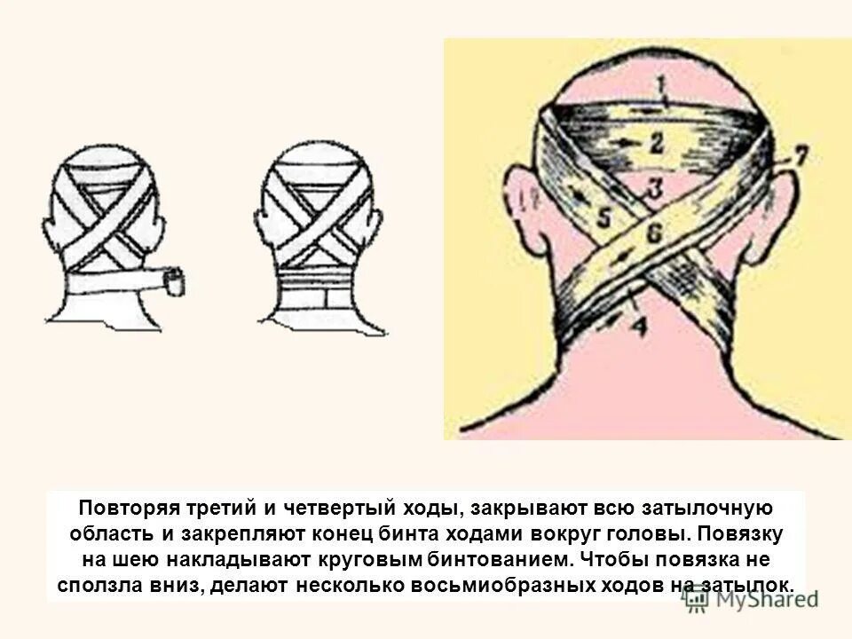 Бинтовая повязка на шею. Наложение повязки на шею. Типы перевязок шея. Повязка на затылочную область.