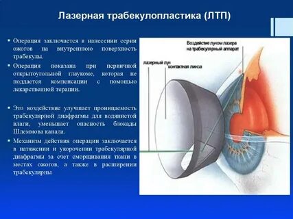 Лазерная операция при глаукоме