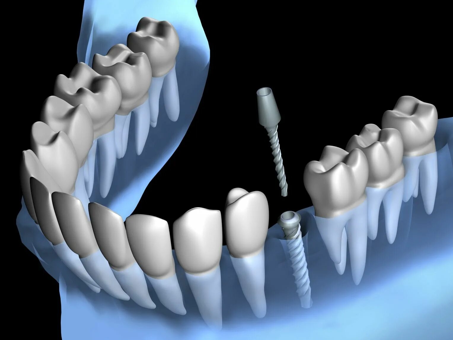 Металлические брекеты. Схема установки брекетов. Ортодонтическое перемещение зуба. Почему зубы двигаются. Ортосмайл муром.
