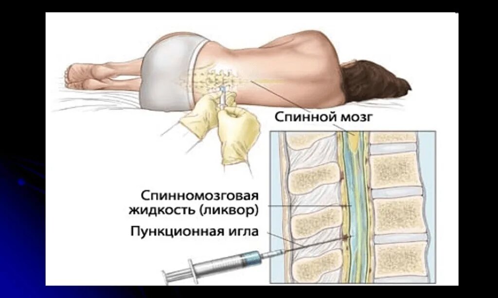 Пункция спинномозговой жидкости. Заболевание при котором показана спинномозговая пункция. Показания к проведению люмбальной пункции.