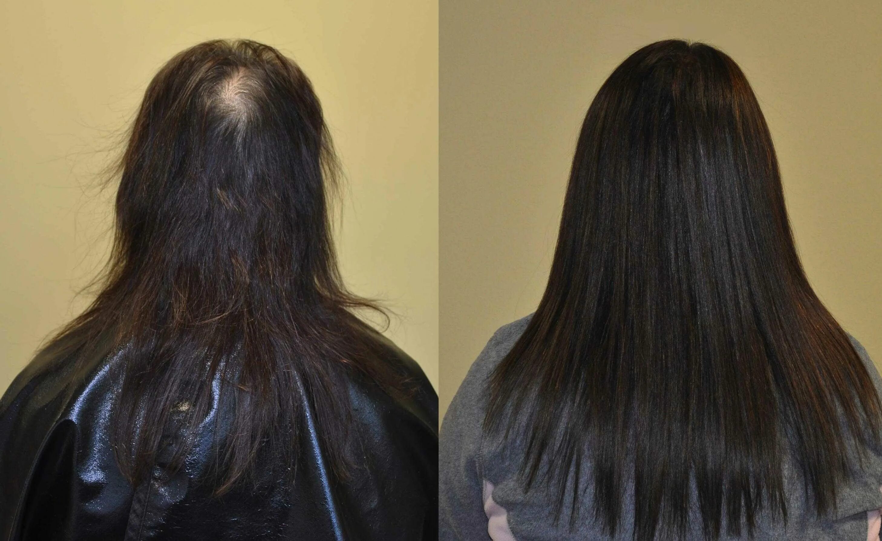 Микрокапсульное наращивание волос при алопеции. Наращивание волос до и после. Нарощенные волосы до и после. Загущение волос наращиванием.
