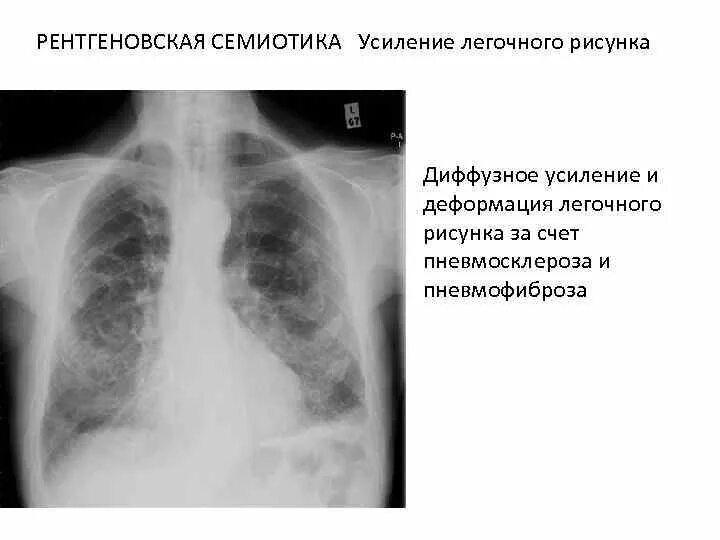 Усиление бронхиального рисунка рентген. Рентген легких усиление легочного рисунка. Рентгеновская семиотика заболеваний органов дыхания. Усиление легочного рисунка.