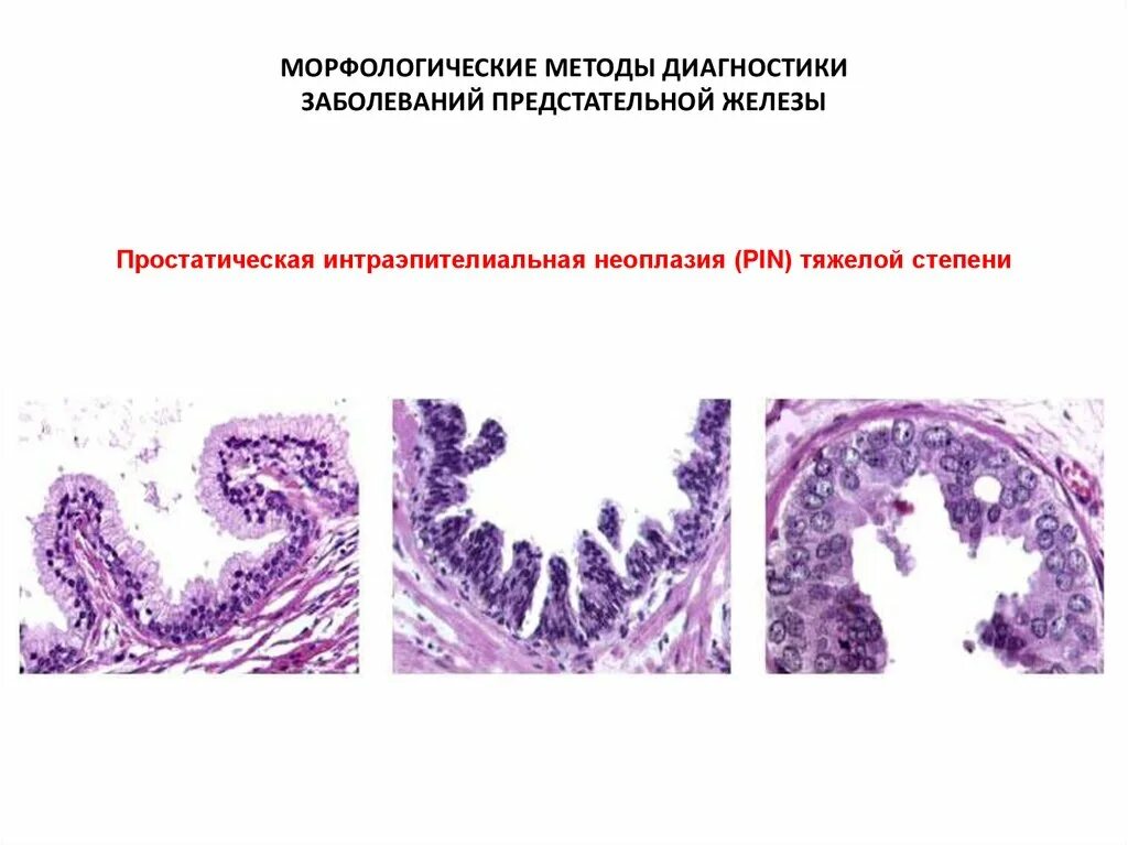 Пин простаты гистология. Простатическая интраэпителиальная неоплазия гистология. Аденома предстательной железы гистология. Карцинома предстательной железы гистология. Дисплазия низкой степени толстой кишки что это