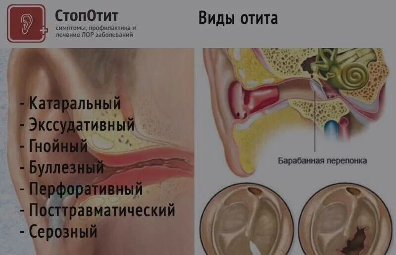 Атит что такое и как лечить. Что такое острый наружный катаральный отит. катаральный и гнойный отит. буллёзный отит барабанная перепонка. острый наружный средний отит.