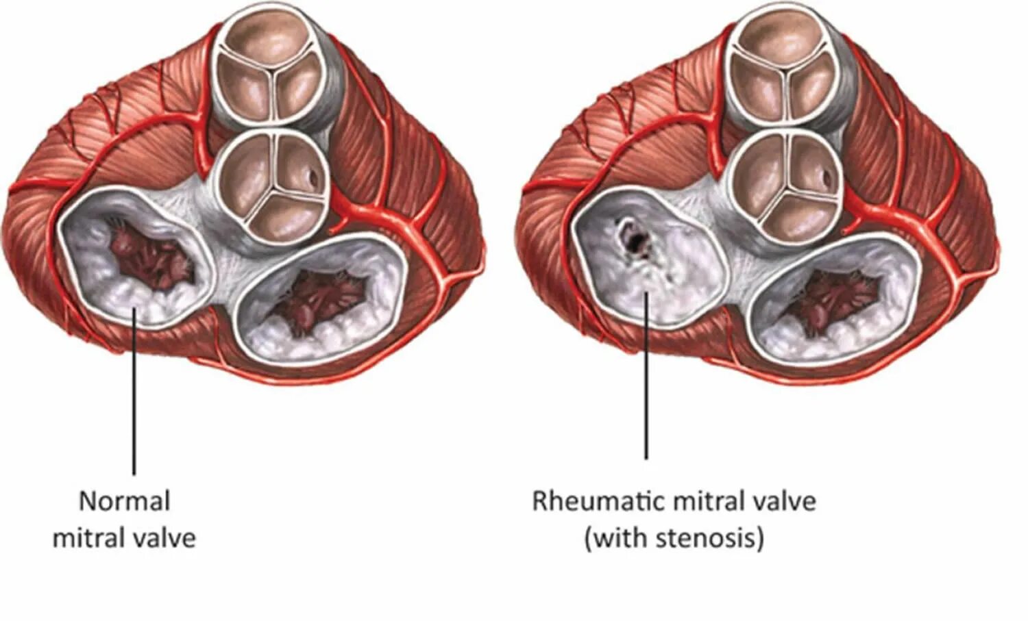 Митральный аортальный стеноз. Стеноз митрального клапана сердца. Ревматизм митральный стеноз. Ревматизм и стеноз митрального клапана. Болезнь сердца митральный стеноз.