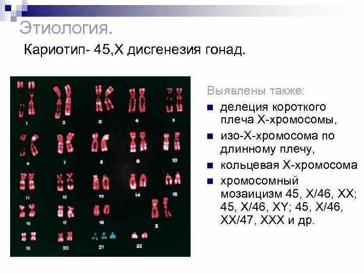 Кариотип 45, х3 46 хх22. Синдром Шерешевского Тернера кариотип. Кариотип y0.