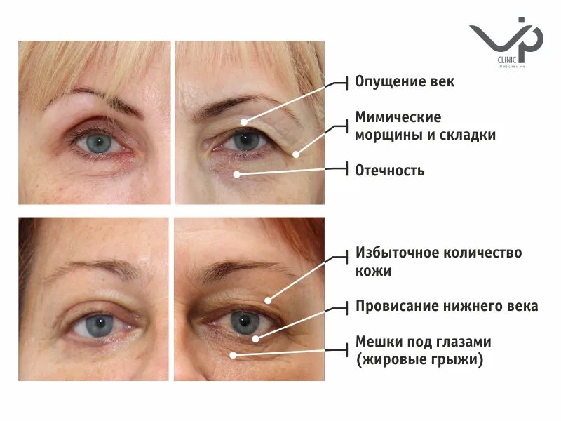 Возрастной птоз верхнего века. Опускание Нижнего века. Опущение Нижнего века после ботокса. Блефаропластика схема. Отчего показать