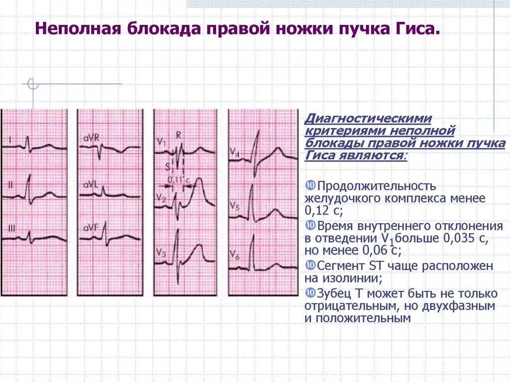 Блокада qrs. ЭКГ признаки блокады ножек пучка Гиса. Блокада правой ножки пучка Гиса на ЭКГ что это на ЭКГ. ЭКГ критерии блокады пучка Гиса. Блокада правой ножек пучка Гиса на ЭКГ.