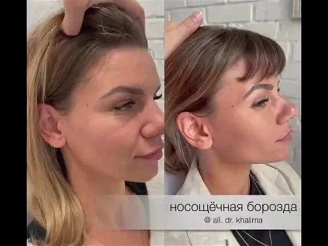 пальберомалярная борозда. филлеры под глаза. носощечная борозда коррекция. носощечная складка. заполнение носослезной борозды филлерами.