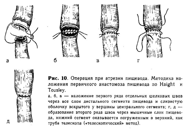 Атрезия пищевода операция. Атрезия пищевода у новорожденных операция. Операции при атрезии пищевода прямой анастомоз. Атрезия пищевода хирургия.