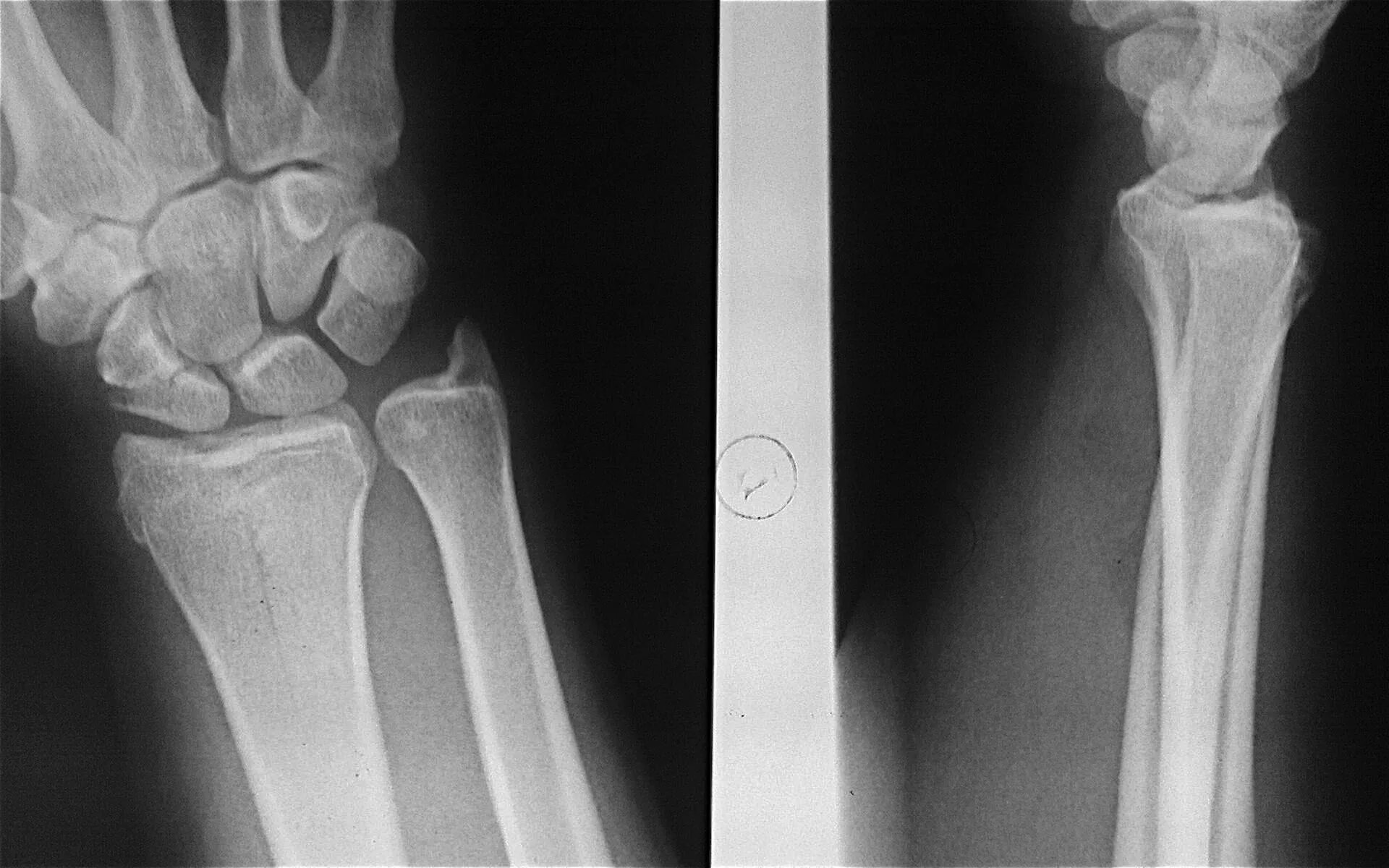 Лучезапястный сустав рентген. Лучезапястный сустав рентген норма. Рентгенограмма лучезапястного сустава в норме. Вывих лучезапястного сустава рентген.