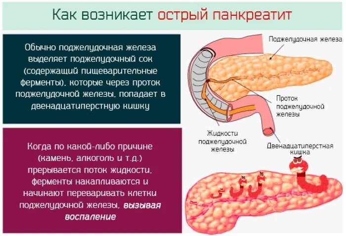 Симптомы при заболевании поджелудочной железе. Острый панкреатит поджелудочной железы. Острый идиопатический панкреатит. Патология поджелудочной железы панкреатит. Симптомы панкреатита поджелудочной железы.