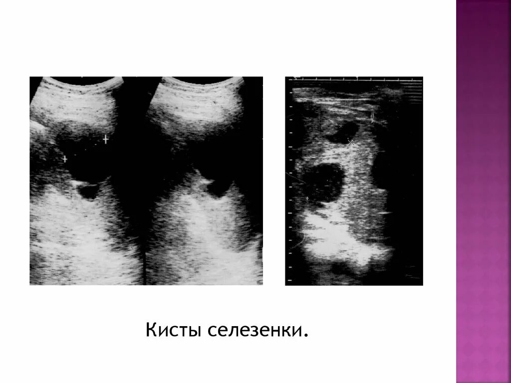 Киста селезенки лечение. Паразитарная киста селезенки УЗИ. Эпидермоидная киста селезенки. Посттравматическая киста селезенки. Атипичная киста селезенки.