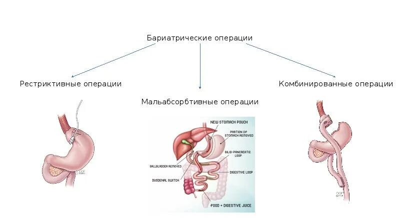 Реконструктивная бариатрическая операция 1 категории сложности. Бариатрия операция желудка что это. Бариатрическая операция на желудке. Бариатрическая операция типы. Бариатрическая хирургия это