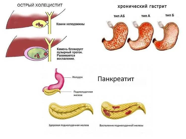 Холецистит панкреатит. Острый холецистит и острый панкреатит. острый холецистит поджелудочная железа. гастрит, язвенная болезнь, панкреатит. хронический холецистит и панкреатит.