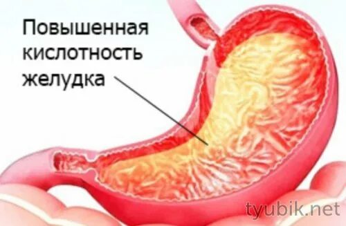 Повышенная кислотность желудка сока. Повышенная кислотность желудка. Желудок с повышенной кислотностью. Повышенное кислотообразование в желудке. Гастрит повышенная кислотность.