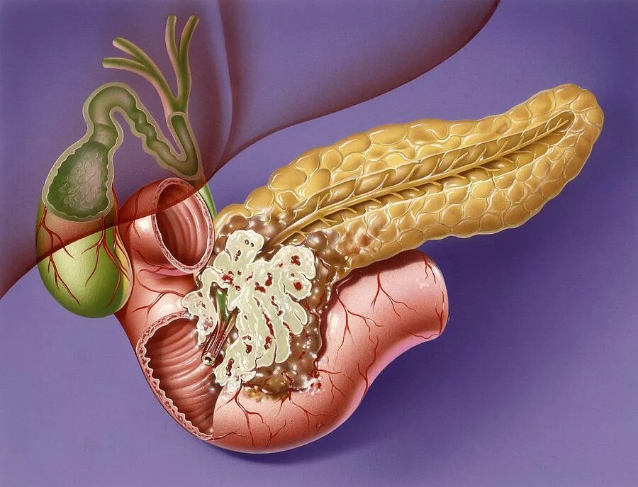 Полностью вылечил панкреатит. Tumor головки поджелудочной железы. Карцинома поджелудочной железы симптомы. Аденокарцинома поджелудочной железы.