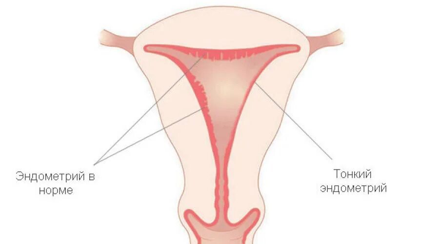 Тонкий эндометрий после