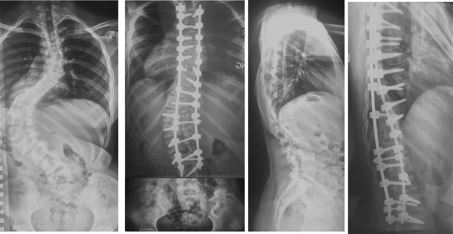 Кифоз 3 степени рентген. Кифосколиоз грудного отдела позвоночника 1 степени. Сколиоз кифоз кифосколиоз. Операция на сколиоз 3 степени. 2 операции на позвоночнике
