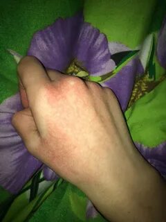 Красные руки у женщины