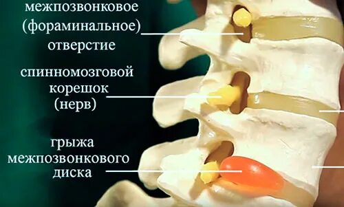 Можно ли греть грыжу поясничного. Протрузии дисков. Протрузия межпозвонковых. Фораминальное отверстие позвоночника. Протрузия межпозвонковых дисков поясничного отдела.