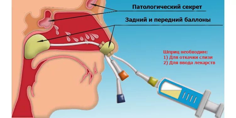 Пункция гайморовой полости. Катетер для промывания гайморовых пазух.