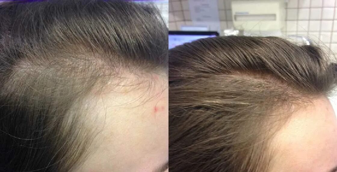 Мезотерапия для волос. Поредение волос у женщин. Мезотерапия волос картинки.