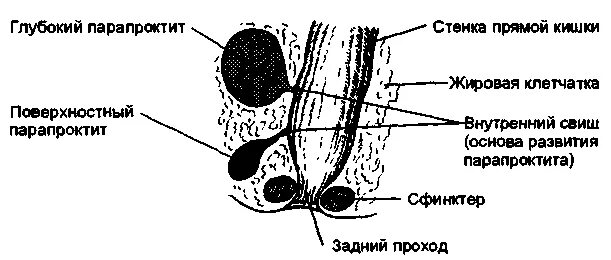 Парапроктит что это симптомы. Поверхностный парапроктит. подкожный парапроктит. линии разрезов при парапроктите.