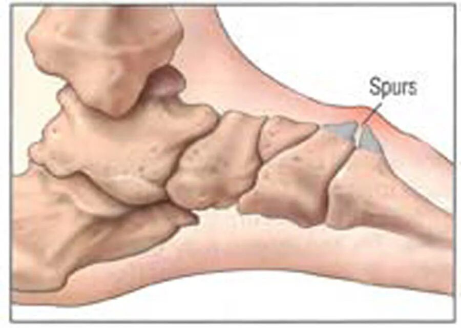 Остеофиты что это такое и как лечить. Пяточная кость остеофит. Краевой остеофит пяточной кости. Остеофит пяточного бугра.