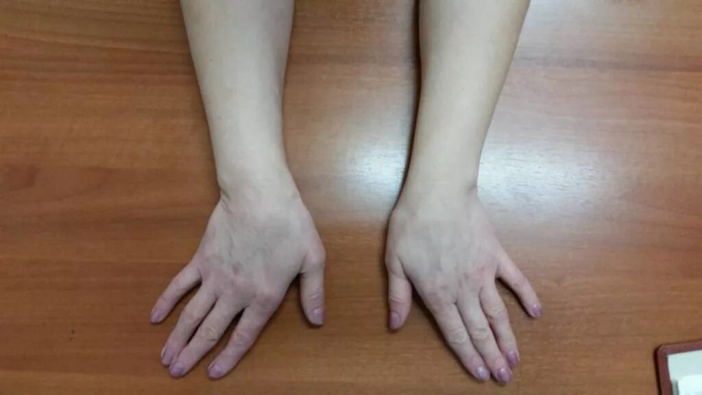 Неправильно сросшийся перелом лучевой кости. Как выглядит рука после. Перелом лучевой кости со смещением. Как выглядит рука после. Штыкообразная деформация лучезапястного сустава.